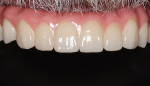 The final zirconia prosthesis was seated with only minimal adjustments needed.