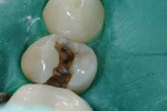 Figure 2  The amalgam was removed, revealing cracks into the dentin buccally and lingually.