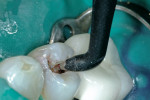 Figure 4  DIAGNOdent was applied to find the caries removal endpoint.