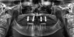 Fig 4. Preoperative panoramic x-ray taken in December 2011. The location of the inferior alveolar nerves and mental foramina must
be noted presurgery.
