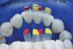 Lingual view with matrices placed to show the change in tooth contour that will be obtained to achieve adequate space closure.