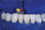 After the injection molding and shaping of tooth No. 24 was completed, tooth No. 25 was matrixed for injection molding.