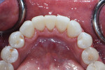 Immediate postoperative retracted occlusal view with the dam removed to show the soft-tissue adaptation.