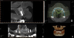 Fig 7. Postoperative CBCT image is used for evaluating the strategic placement of the dental implants.