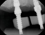 Fig 12. Individual inlay resin jigs are fabricated by the dental laboratory to ensure a passive fit of the final framework.