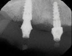 Fig 25. Digital periapical radiographs are taken of the multiunit abutments.