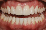 Figure 10  Full-mouth bleaching, minimal preparation feldspathic veneers on teeth Nos. 6 to 11, and a leucite-reinforced retoration on tooth No. 25 fulfilled the patient’s objectives