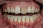 Figure 13  This patient presented with an extremely discolored tooth No. 9 and a midline diastema.