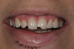 Figure 1  Preoperative smile 1 day after trauma showing chipped maxillary teeth Nos. 7, 8, and 9.