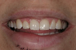 Figure 2  Preoperative smile after restoring shape and contours with composite resin.