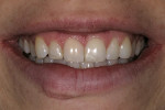Figure 3  Preoperative smile 1 month after the initial trauma. Note the lower value of tooth No. 8.