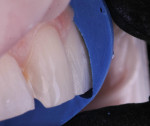 Facial reduction in three distinct planes with additional incisal reduction.