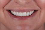 Postoperative full smile photograph displaying the esthetic result achieved.