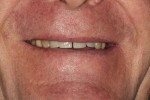 Fig 4. The diastema between teeth Nos. 8 and 9 is revealed in the initial full-smile photograph.
