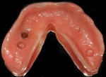 Fig 6. The ventral surface of the mandibular immediate complete denture has a soft reline and a locator attachment that was picked up directly.