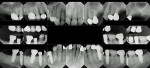 Fig 1. Initial full-mouth x-rays; note good bone height and multiple structurally compromised teeth with recurrent decay and periapical abscesses.