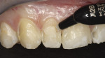 Figure 6  Application of the higher-chroma base shade A2B prevented the darker color of the affected dentin from showing through.