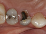 Figure 2  Preoperative occlusal view of tooth No. 5.