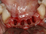 Figure 8  Post-extraction view of teeth Nos. 23, 24, 25, and 26 after careful removal with forceps.