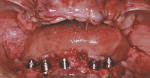 Figure 4  Five NanoTite<sup>TM</sup>Tapered Implants were placed in the mandible, with the two posterior implants tilted distally.
