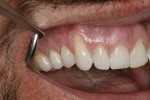 Fig 8. Case 1, pretreatment. Recession, mucogingival involvement, and cervical abrasion were present.
