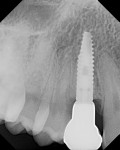 Fig 2. Radiograph taken 2 years 4 months after restoration showed bone to the implant abutment connection.
