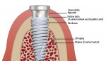 Fig 5. Diagram of the implant design with concave healing abutment design followed in this study.