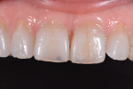 Fig 3. Retracted 1:1 view showed the translucent incisal third and Class 5 composite restorations.