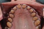 Fig 10. The maxillary teeth are prepared according to the wax-up using PVS reduction guides.
