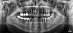 Fig 1. Preoperative panographic radiograph revealing missing tooth No. 15 and extent of localized periodontitis at tooth No. 16.