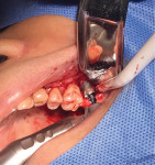 Fig 8. The implant with bone graft material was atraumatically inserted in a flapless procedure.