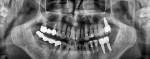 Fig 14. An 18-month panographic radiograph also confirmed the successful integration of the implant at the No. 15 site, as well as two implants subsequently placed in the opposing mandibular sites.