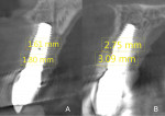 Fig 8. Comparative CBCT measurements were made between T (A) and INV (B) implant groups at L1 and L2. The INV implants showed statistically significant differences at both levels (P ≤ .05) of 1.66 mm (L1) and 1.77 mm (L2), respectively.