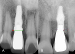 Fig 9. Comparative periapical measurements were made between T (A) and INV (B) implant groups. The INV implants showed a statistically significant difference of 0.97 mm greater distance between central and lateral incisors.