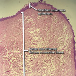 Fig 8. Photomicrograph at low power demonstrated stratified squamous epithelium overlying abundant, dense, non-inflamed fibrous connective tissue.