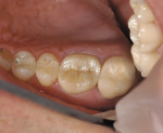 Figure 7  The shade match of the MZ crown on tooth No. 3 has become more predictable.