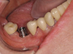 Figure 11  A metal abutment for a MZ crown.