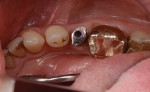 Fig 12. Occlusal view of novel impression coping.