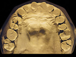 Figure 2  Advanced NCLTS from bruxism, mandibular arch.