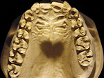 Figure 5  Moderate NCLTS from bruxism, maxillary arch.