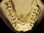 Figure 6  Moderate NCLTS from bruxism, mandibular arch.