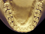 Figure 8  Moderate NCLTS from toothpaste, mandibular arch.