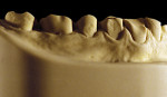 Figure 13  Advanced NCLTS from toothpaste, right facial view.