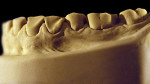 Figure 14  Advanced NCLTS from toothpaste, left facial view.