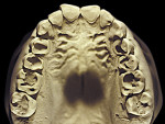 Figure 15  Moderate NCLTS from regurgitation, maxillary arch.