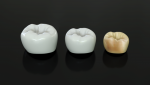 FIG 2. The processing steps of Lithoz zirconia crowns include, from left, the green body; the white body; and the finished crown after staining, glazing, and firing.