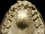 Figure 22  Advanced NCLTS from soda-swishing, maxillary arch.