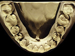 Figure 23  Advanced NCLTS from soda-swishing, mandibular arch.