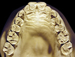 Figure 24  Moderate NCLTS from fruit-mulling, maxillary arch.