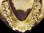 Figure 25  Moderate NCLTS from fruit-mulling, mandibular arch.